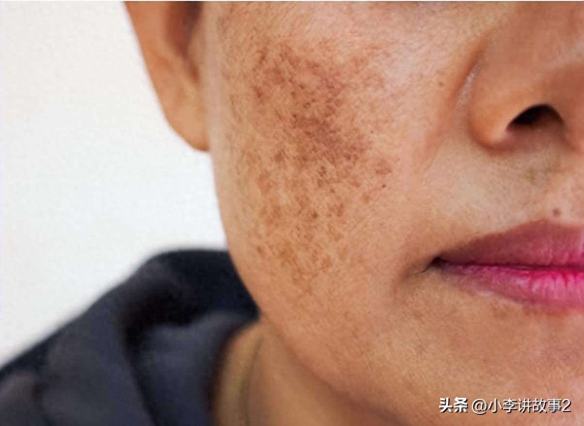 皮肤科医生免费问诊,脸颊两边长黄褐斑怎么去除，为什么有的人脸上长满了“老年斑”，而有的人却很干净？