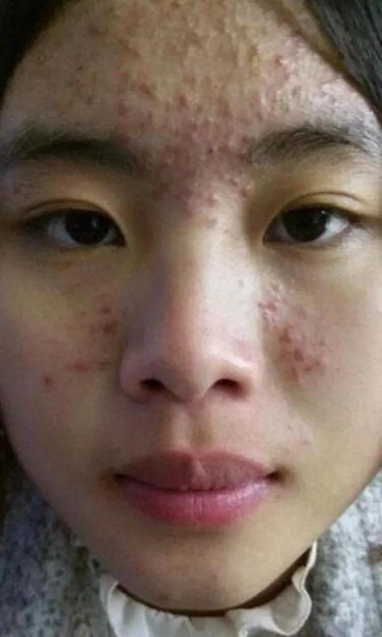 脸颊两侧长一片斑的原因,皮肤科医生免费问诊，青春痘（痤疮）的烦恼