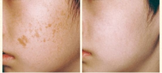 脸上的色斑怎样才能去掉,皮肤长斑用什么办法可以清除，令人困扰的色斑问题，应该怎么才能把它去掉呢？