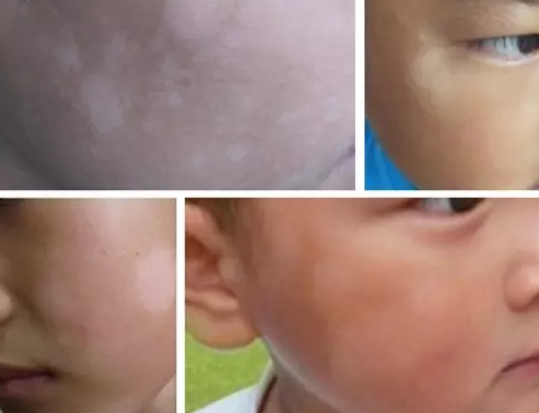 小孩蛔虫脸上白斑图片,白点癫风和白斑的区别，注意！孩子脸上的白斑不是因为蛔虫，而是……
