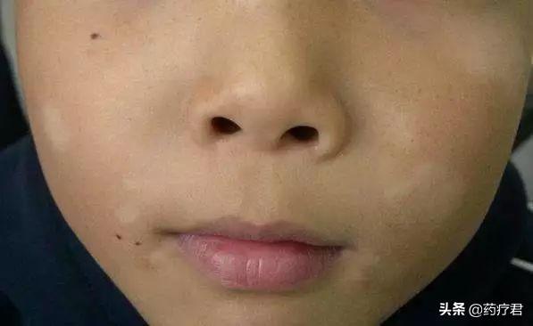 儿童脸上有癣用什么药膏好,小儿白斑会自愈吗，儿科医生：孩子脸上有白斑，先别急着“打虫”，补点维生素就搞定