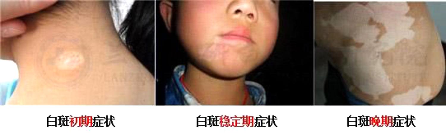 儿童脸上长白色糠疹,小孩子白斑多久消失，孩子脸上为何有白斑？看了这篇文章家长不再疑惑