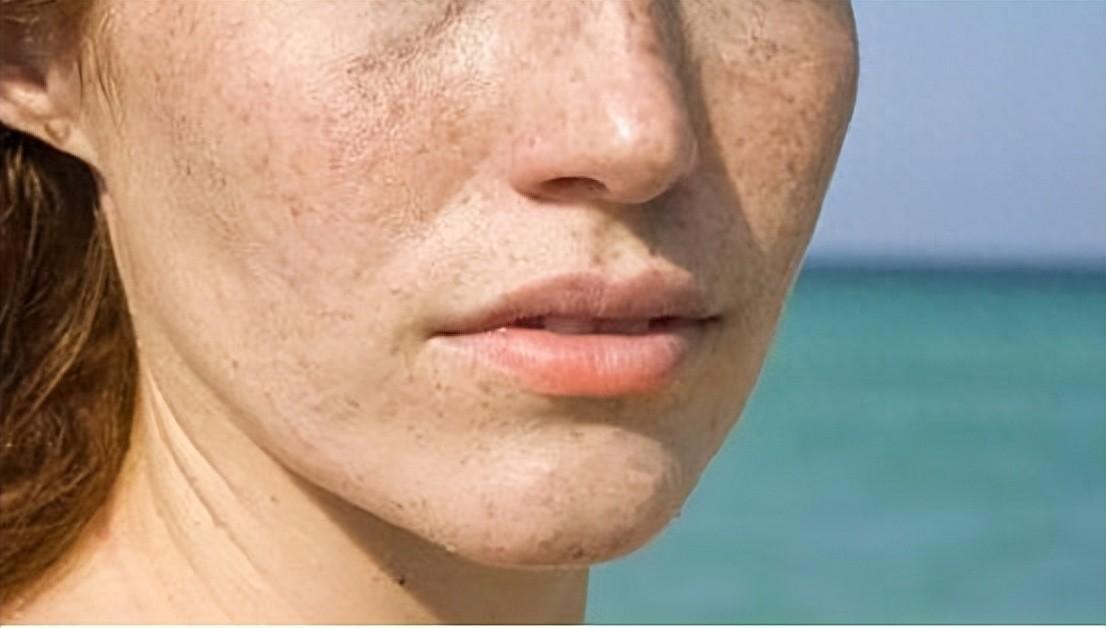 淡化脸上斑的最好方法,脸上长斑怎么才能消除，色斑成因揭秘，为什么它们出现在你的皮肤上？